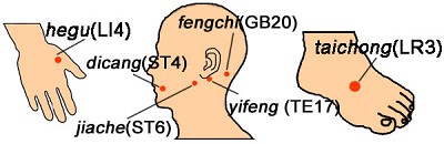 Facial Paralysis